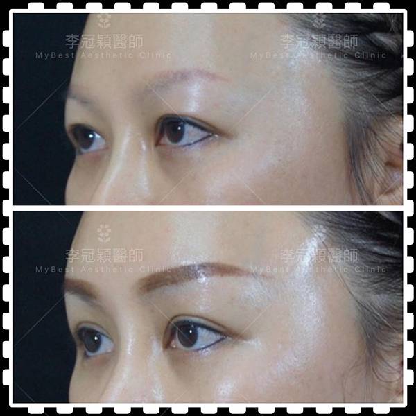 五爪提眉拉皮髮際線會後移嗎?怎麼辦? 五爪提眉拉皮髮際線會後移嗎?怎麼辦?