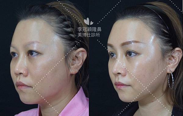 五爪提眉拉皮髮際線會後移嗎?怎麼辦? 五爪提眉拉皮髮際線會後移嗎?怎麼辦?