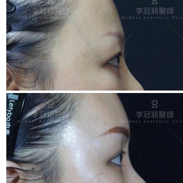 五爪提眉拉皮髮際線會後移嗎?怎麼辦? 五爪提眉拉皮髮際線會後移嗎?怎麼辦?