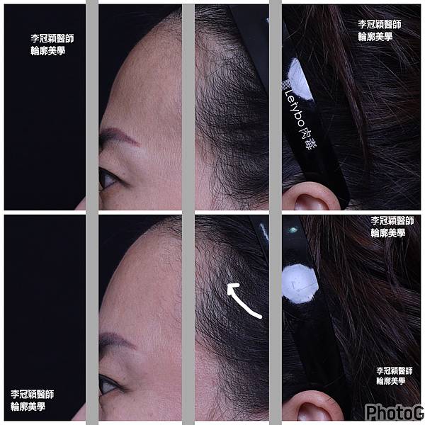 五爪提眉拉皮髮際線會後移嗎?怎麼辦? 五爪提眉拉皮髮際線會後移嗎?怎麼辦?