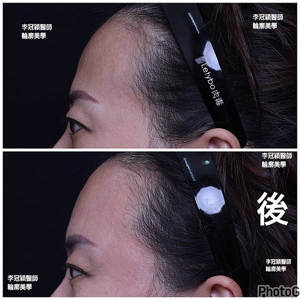 五爪提眉拉皮髮際線會後移嗎?怎麼辦? 五爪提眉拉皮髮際線會後移嗎?怎麼辦?