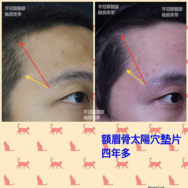 五爪提眉拉皮髮際線會後移嗎?怎麼辦? 五爪提眉拉皮髮際線會後移嗎?怎麼辦?