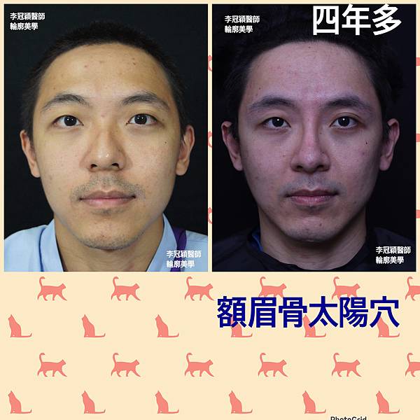 五爪提眉拉皮髮際線會後移嗎?怎麼辦? 五爪提眉拉皮髮際線會後移嗎?怎麼辦?