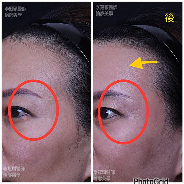 五爪提眉拉皮髮際線會後移嗎?怎麼辦? 五爪提眉拉皮髮際線會後移嗎?怎麼辦?