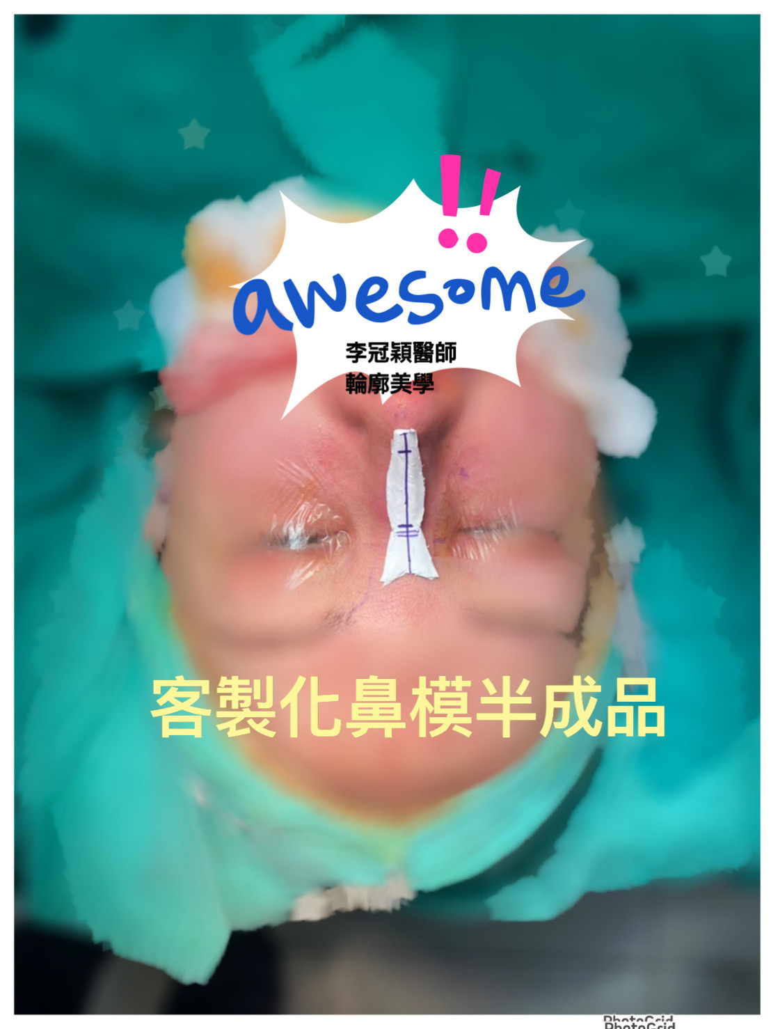 隆鼻最好材料? 誰不容易取出?誰會感染?誰會吸收變形?搶救 隆鼻最好材料? 誰不容易取出?誰會感染?誰會吸收變形?搶救