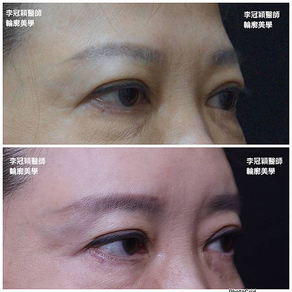 五爪提眉拉皮髮際線會後移嗎?怎麼辦? 五爪提眉拉皮髮際線會後移嗎?怎麼辦?