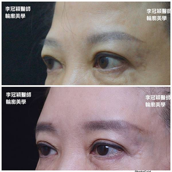 五爪提眉拉皮髮際線會後移嗎?怎麼辦? 五爪提眉拉皮髮際線會後移嗎?怎麼辦?