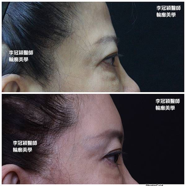 五爪提眉拉皮髮際線會後移嗎?怎麼辦? 五爪提眉拉皮髮際線會後移嗎?怎麼辦?