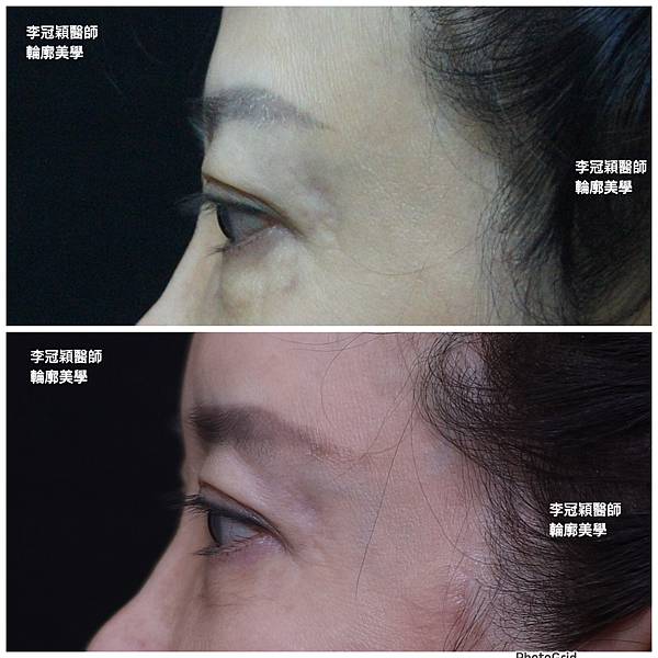 五爪提眉拉皮髮際線會後移嗎?怎麼辦? 五爪提眉拉皮髮際線會後移嗎?怎麼辦?