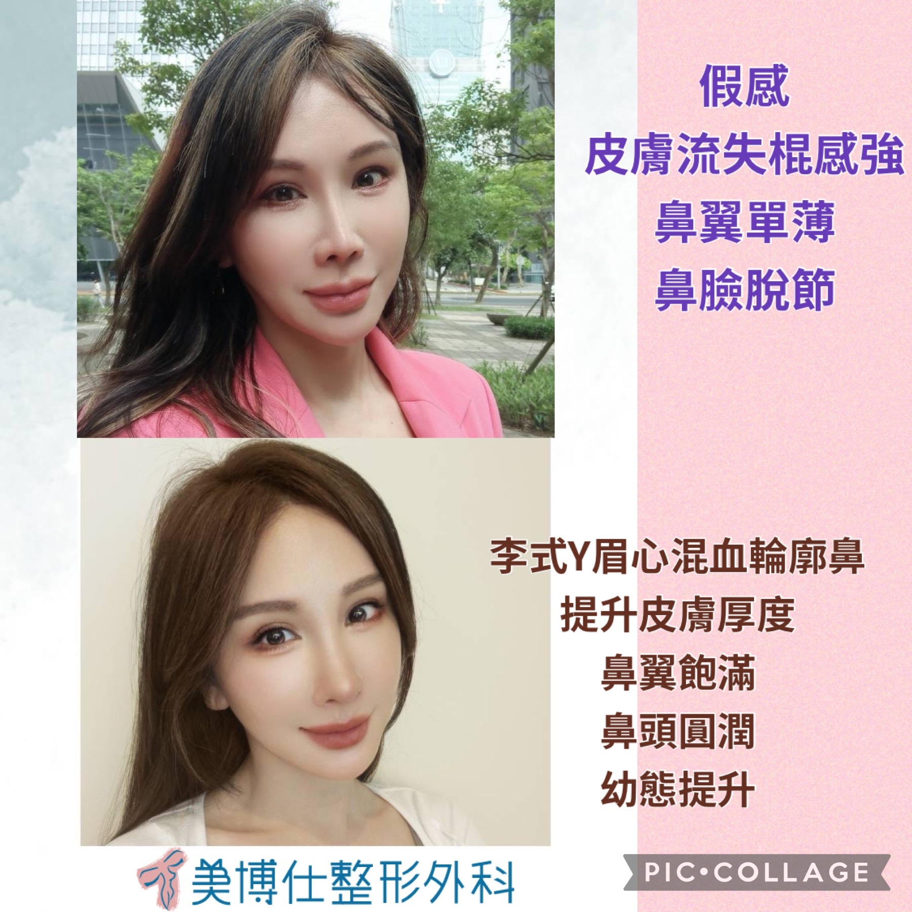 隆鼻最好材料? 誰不容易取出?誰會感染?誰會吸收變形?搶救 隆鼻最好材料? 誰不容易取出?誰會感染?誰會吸收變形?搶救