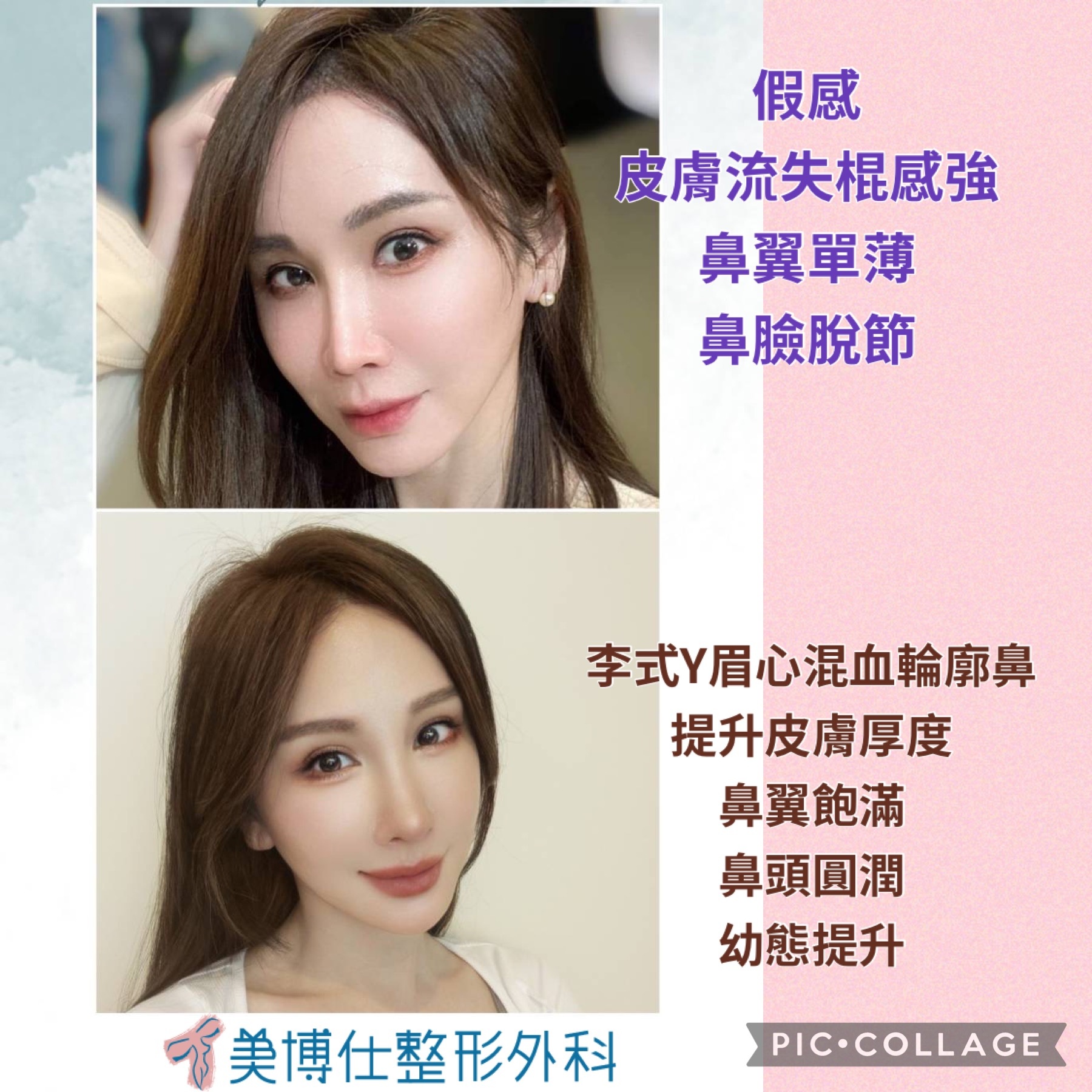 隆鼻最好材料? 誰不容易取出?誰會感染?誰會吸收變形?搶救 隆鼻最好材料? 誰不容易取出?誰會感染?誰會吸收變形?搶救