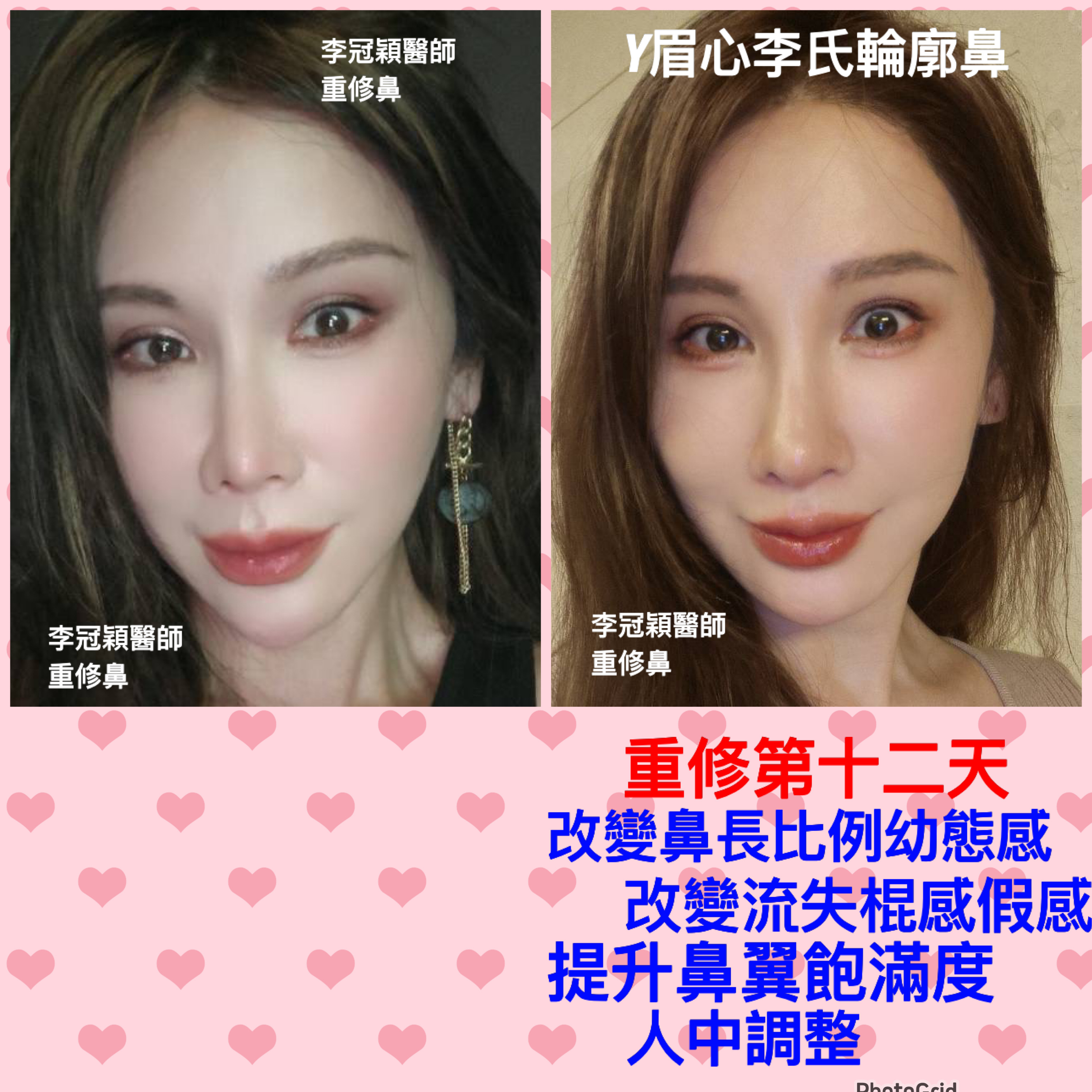 隆鼻最好材料? 誰不容易取出?誰會感染?誰會吸收變形?搶救 隆鼻最好材料? 誰不容易取出?誰會感染?誰會吸收變形?搶救