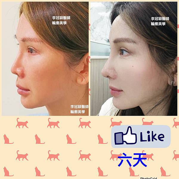 搶救失敗隆鼻三:沒有條件如何隆鼻?正解:輪廓解析隆鼻術(避免 搶救失敗隆鼻三:沒有條件如何隆鼻?正解:輪廓解析隆鼻術(避免