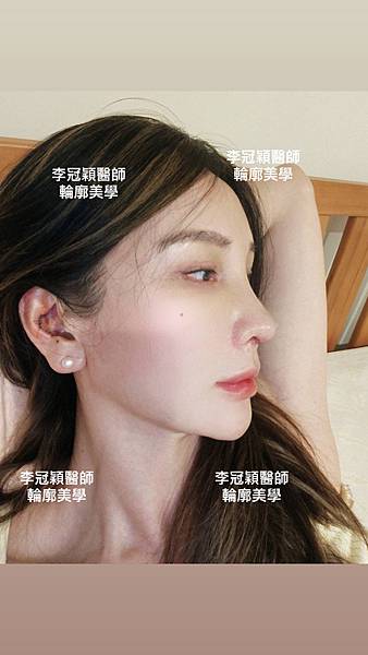 搶救失敗隆鼻三:沒有條件如何隆鼻?正解:輪廓解析隆鼻術(避免 搶救失敗隆鼻三:沒有條件如何隆鼻?正解:輪廓解析隆鼻術(避免