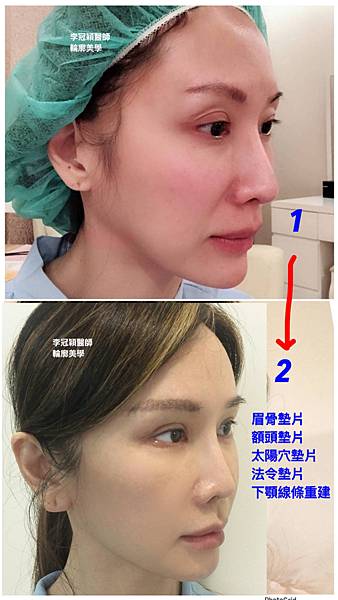 搶救失敗隆鼻三:沒有條件如何隆鼻?正解:輪廓解析隆鼻術(避免 搶救失敗隆鼻三:沒有條件如何隆鼻?正解:輪廓解析隆鼻術(避免