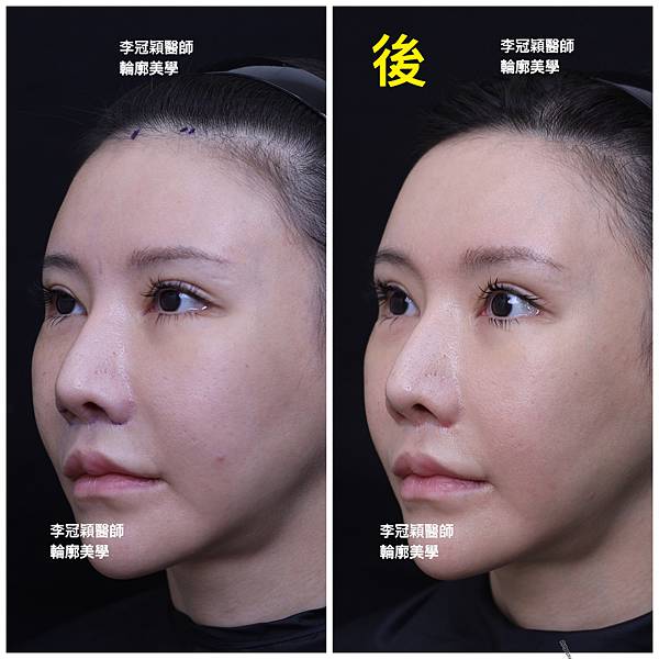 五爪提眉拉皮髮際線會後移嗎?怎麼辦? 五爪提眉拉皮髮際線會後移嗎?怎麼辦?