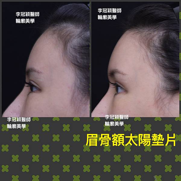 五爪提眉拉皮髮際線會後移嗎?怎麼辦? 五爪提眉拉皮髮際線會後移嗎?怎麼辦?