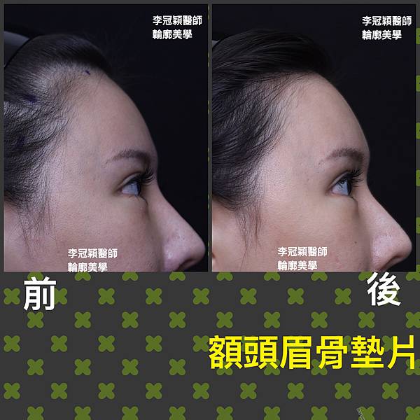 五爪提眉拉皮髮際線會後移嗎?怎麼辦? 五爪提眉拉皮髮際線會後移嗎?怎麼辦?