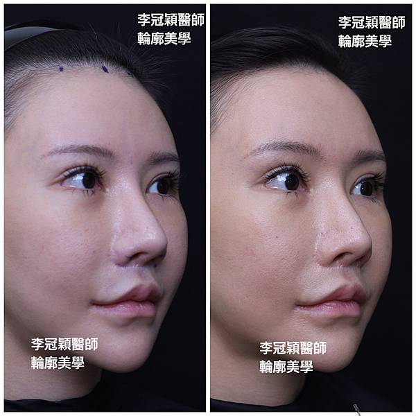 五爪提眉拉皮髮際線會後移嗎?怎麼辦? 五爪提眉拉皮髮際線會後移嗎?怎麼辦?