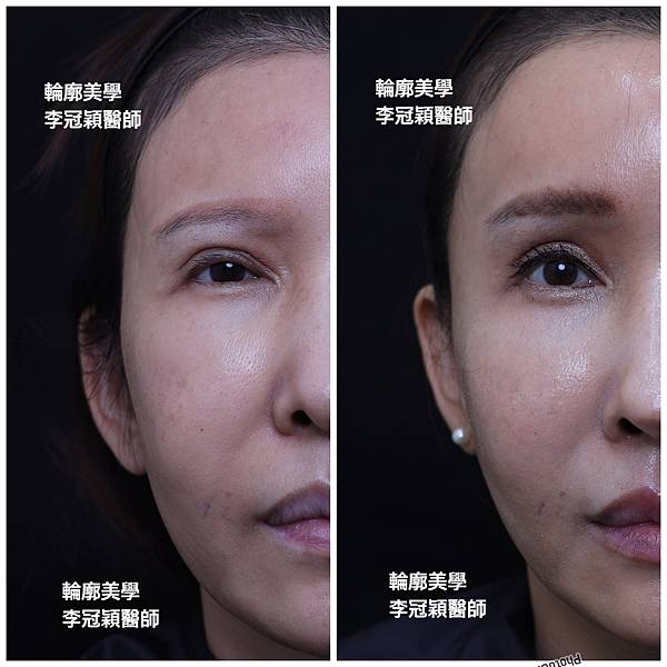 五爪提眉拉皮髮際線會後移嗎?怎麼辦? 五爪提眉拉皮髮際線會後移嗎?怎麼辦?