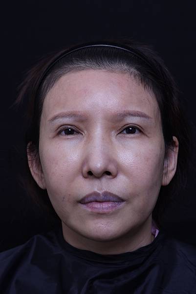 五爪提眉拉皮髮際線會後移嗎?怎麼辦? 五爪提眉拉皮髮際線會後移嗎?怎麼辦?