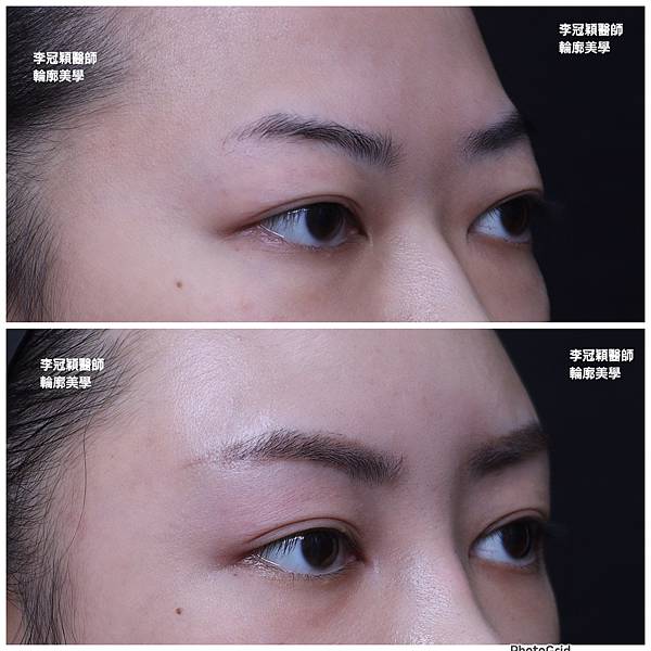 五爪提眉拉皮髮際線會後移嗎?怎麼辦? 五爪提眉拉皮髮際線會後移嗎?怎麼辦?