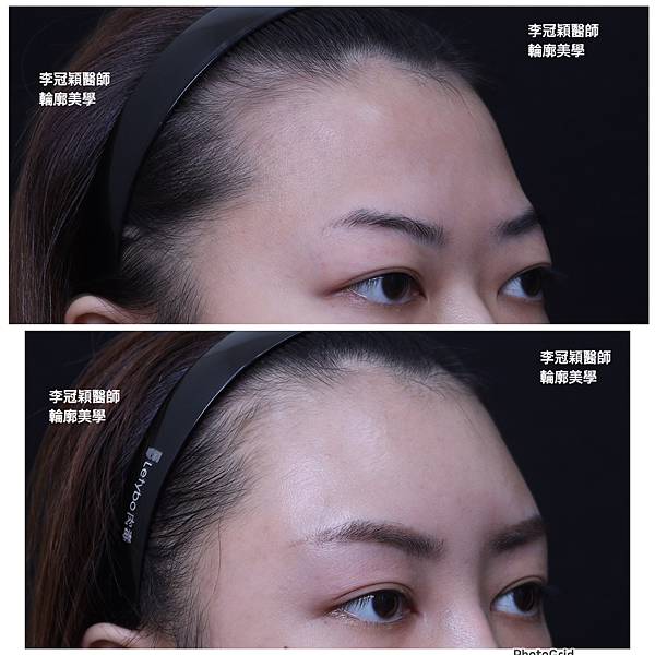 五爪提眉拉皮髮際線會後移嗎?怎麼辦? 五爪提眉拉皮髮際線會後移嗎?怎麼辦?