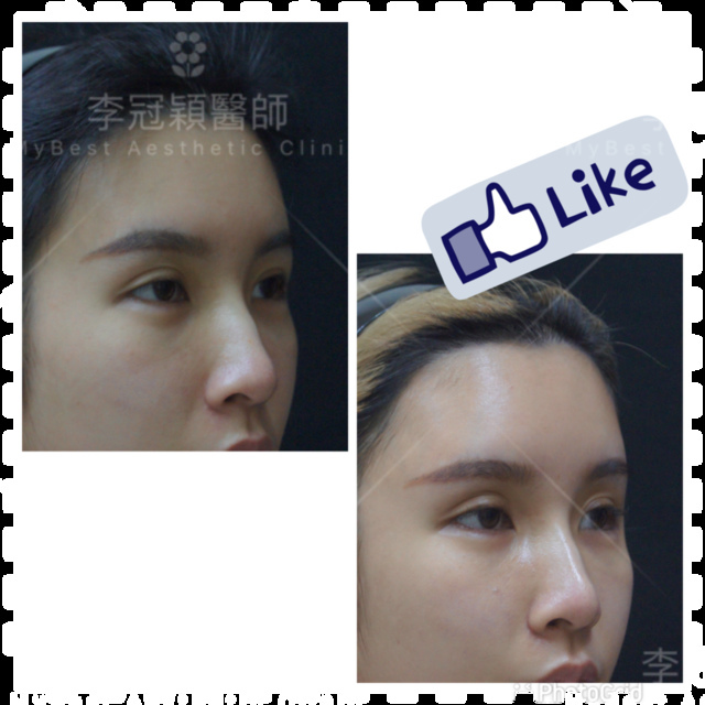 還在注射豐額頭嗎? 微創內視鏡精準豐額頭(墊額頭)不再讓妳掀 IMG_5037.PNG - 墊額頭
