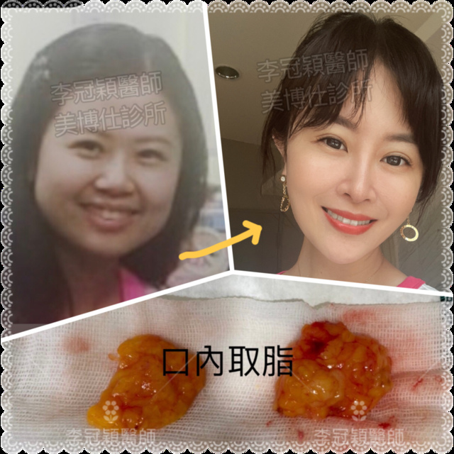 除了小Ｖ臉，妳還少了什麼？側臉的顏值骨性線條-下顎線，下巴線