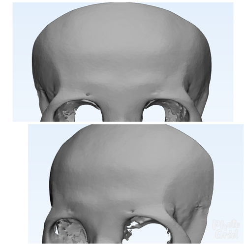 還在注射豐額頭嗎? 微創內視鏡精準豐額頭(墊額頭)不再讓妳掀 IMG_5C7D6711EC94-1.jpeg - 墊額頭