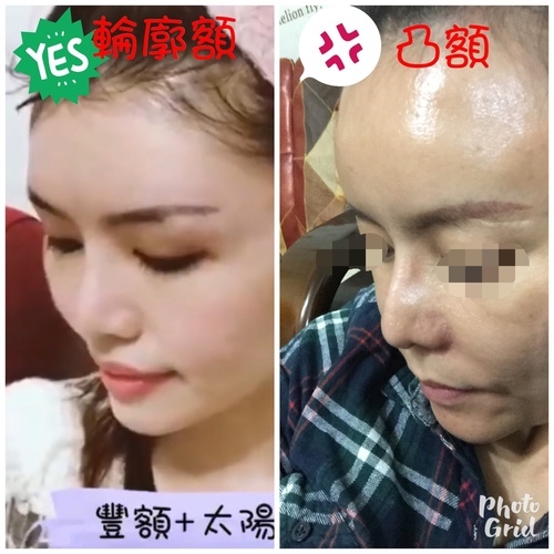 IMG_6620.JPG - 墊額頭