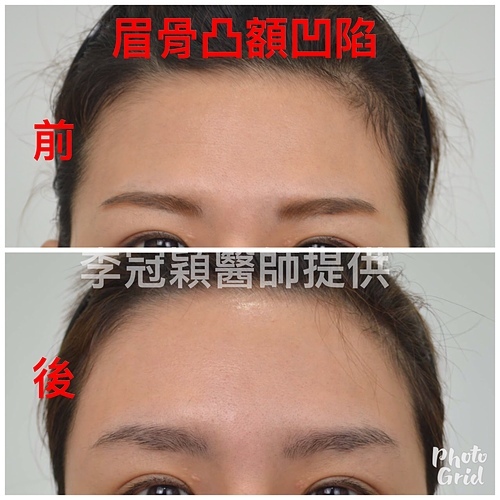 ABD47802-2983-4E96-847E-07D67B0AB7AC.jpg - 墊額頭