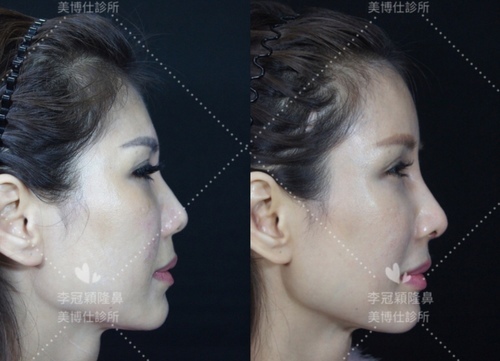 還在注射豐額頭嗎? 微創內視鏡精準豐額頭(墊額頭)不再讓妳掀 還在注射豐額頭嗎? 微創內視鏡精準豐額頭(墊額頭)不再讓妳掀