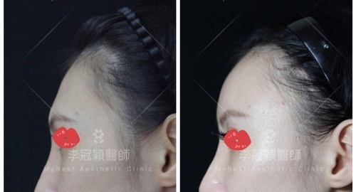 還在注射豐額頭嗎? 微創內視鏡精準豐額頭(墊額頭)不再讓妳掀 IMG_2738.JPG - 墊額頭