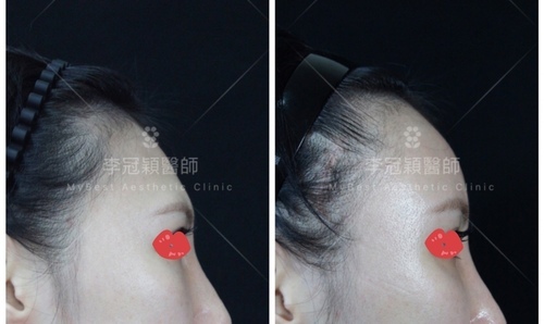 還在注射豐額頭嗎? 微創內視鏡精準豐額頭(墊額頭)不再讓妳掀 IMG_2739.JPG - 墊額頭