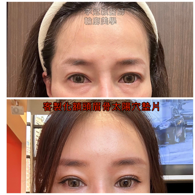 還在注射豐額頭嗎? 微創內視鏡精準豐額頭(墊額頭)不再讓妳掀 IMG_4511.JPG - 額眉