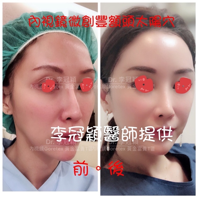 還在注射豐額頭嗎? 微創內視鏡精準豐額頭(墊額頭)不再讓妳掀 還在注射豐額頭嗎? 微創內視鏡精準豐額頭(墊額頭)不再讓妳掀