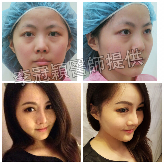 還在注射豐額頭嗎? 微創內視鏡精準豐額頭(墊額頭)不再讓妳掀 20150902_101605000_iOS.jpg - 墊額頭