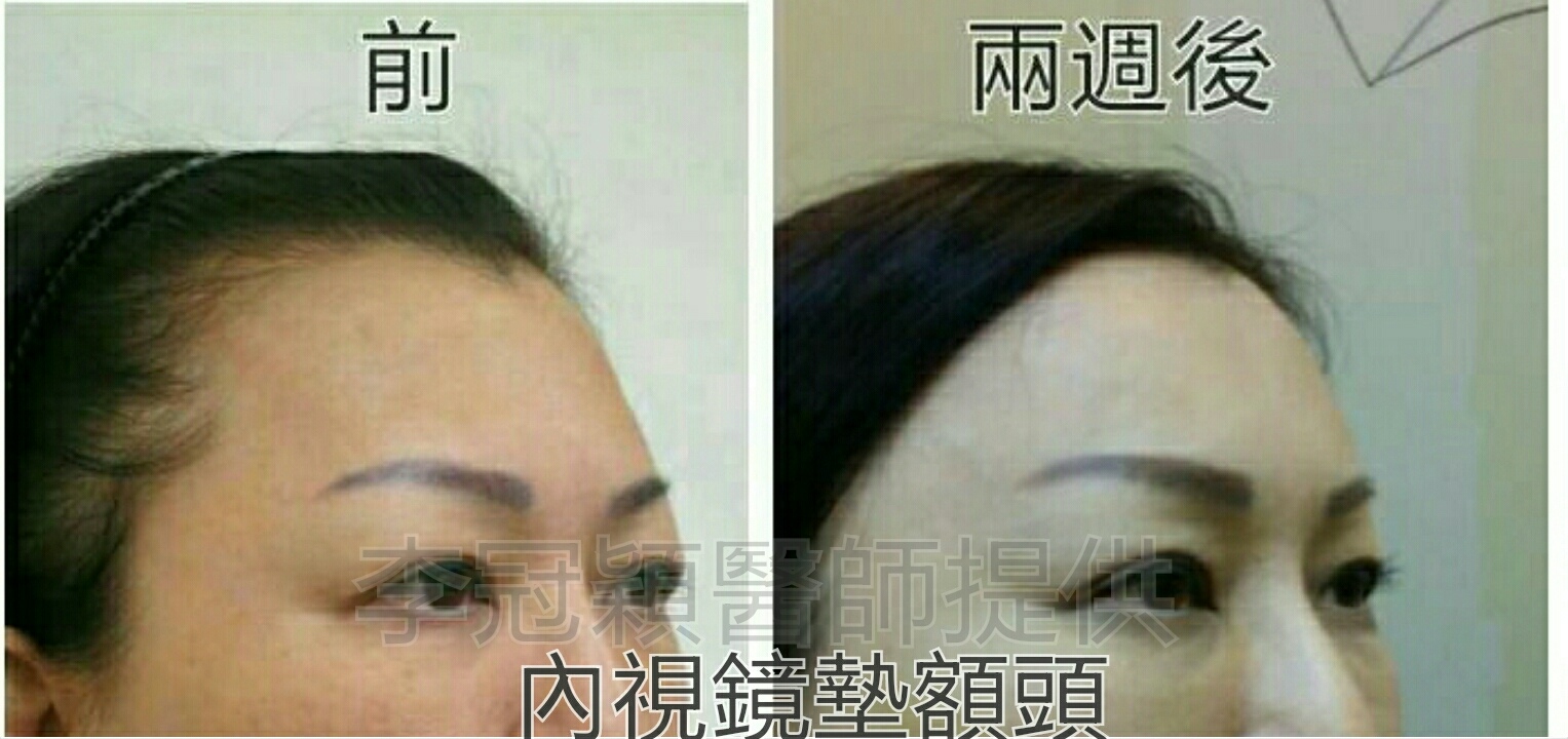 還在注射豐額頭嗎? 微創內視鏡精準豐額頭(墊額頭)不再讓妳掀 還在注射豐額頭嗎? 微創內視鏡精準豐額頭(墊額頭)不再讓妳掀