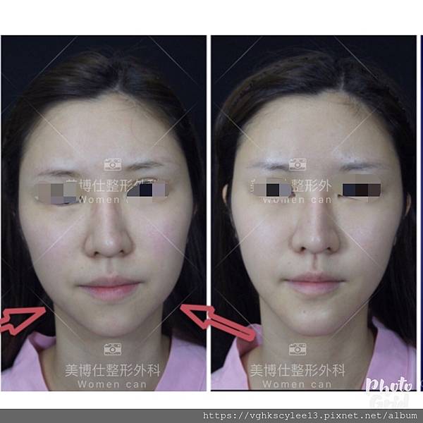 除了小Ｖ臉，妳還少了什麼？側臉的顏值骨性線條-下顎線，下巴線