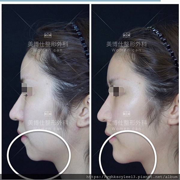 除了小Ｖ臉，妳還少了什麼？側臉的顏值骨性線條-下顎線，下巴線