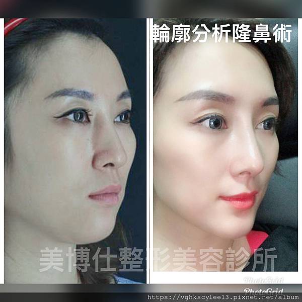 搶救失敗隆鼻三：鼻子條件差也能成功隆鼻嗎？關鍵在『輪廓解析隆鼻術』– 李冠穎醫師解析