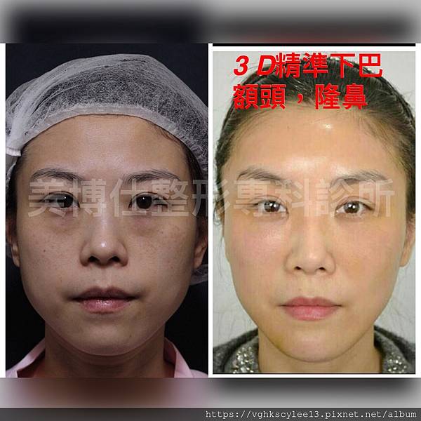 除了小Ｖ臉，妳還少了什麼？側臉的顏值骨性線條-下顎線，下巴線