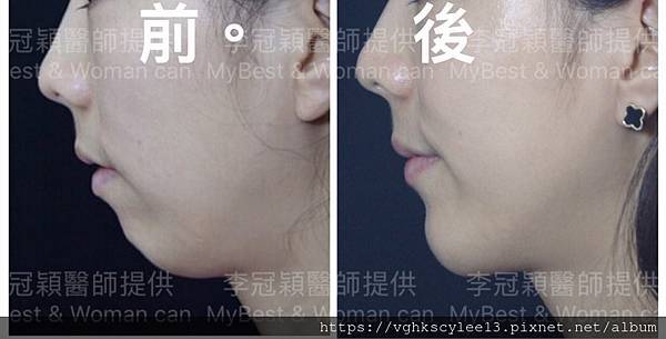 除了小Ｖ臉，妳還少了什麼？側臉的顏值骨性線條-下顎線，下巴線