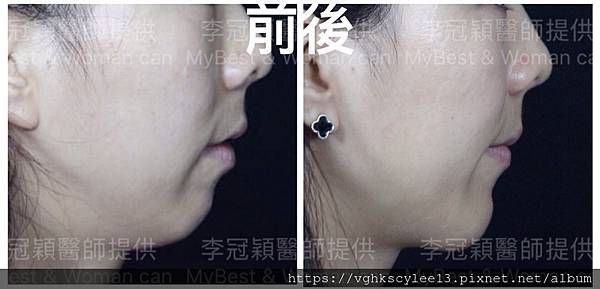 除了小Ｖ臉，妳還少了什麼？側臉的顏值骨性線條-下顎線，下巴線