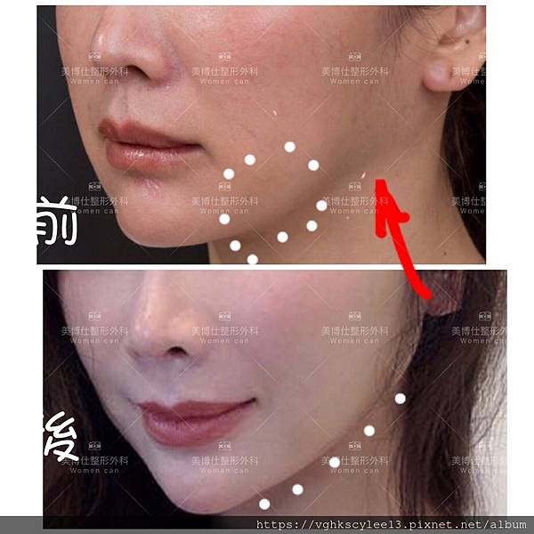 除了小Ｖ臉，妳還少了什麼？側臉的顏值骨性線條-下顎線，下巴線