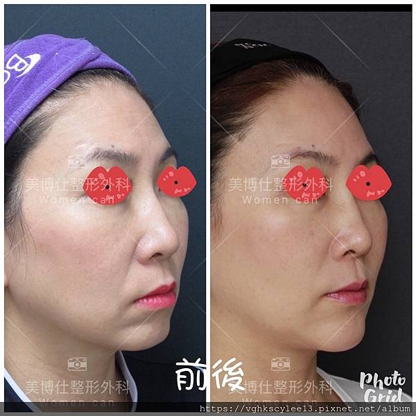 除了小Ｖ臉，妳還少了什麼？側臉的顏值骨性線條-下顎線，下巴線