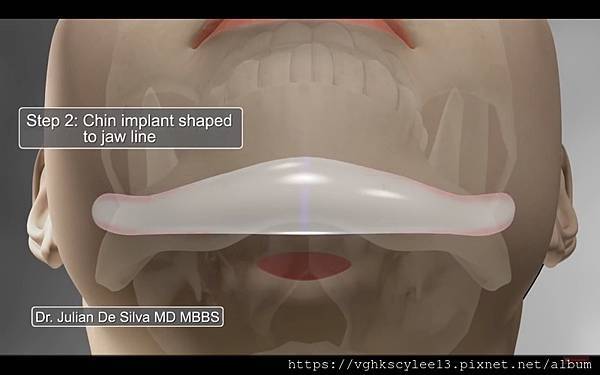 墊下巴手術