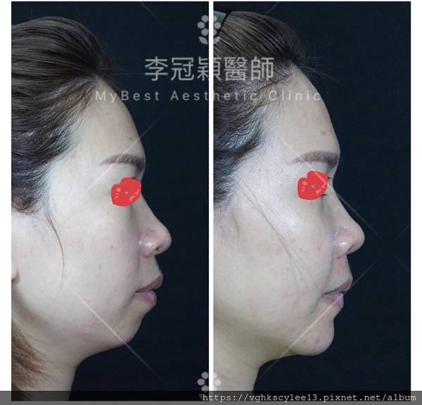 墊下巴手術