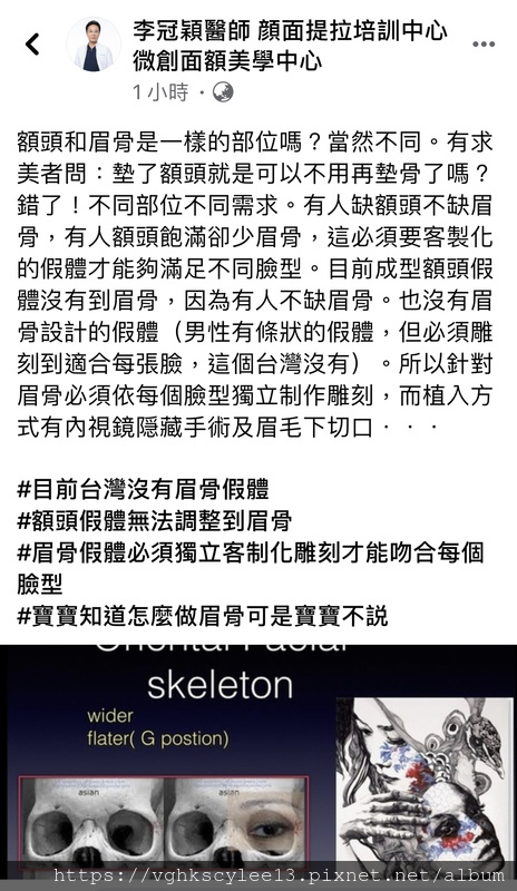 妳的豐額是哪一款的？雕塑輪廓額、假體凸額還是注射膨額？眉骨的